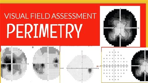 automated perimetry test results interpretation|HOW TO UNDERSTAND IT How to interpret visual fields.